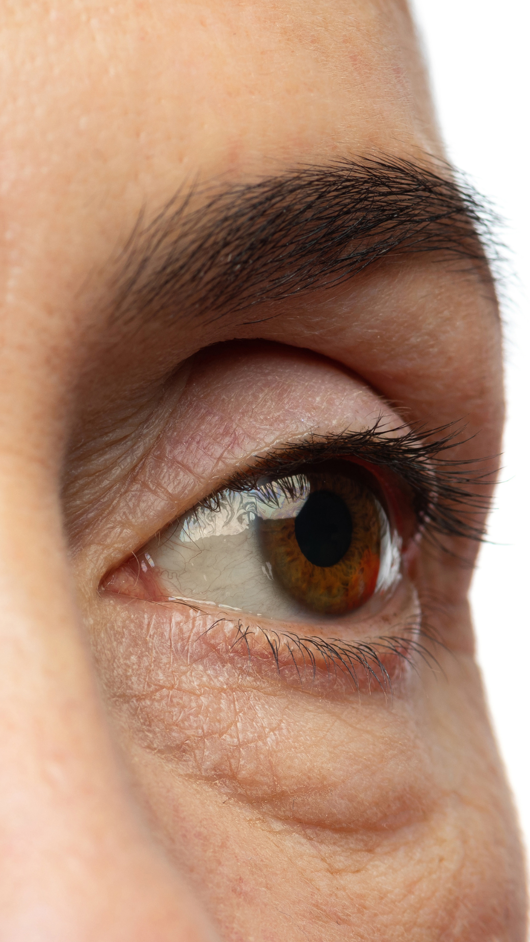 Bags under eyes treatment – advanced eye rejuvenation at It’s Me & You Clinic Kingston upon Thames, Surrey, London