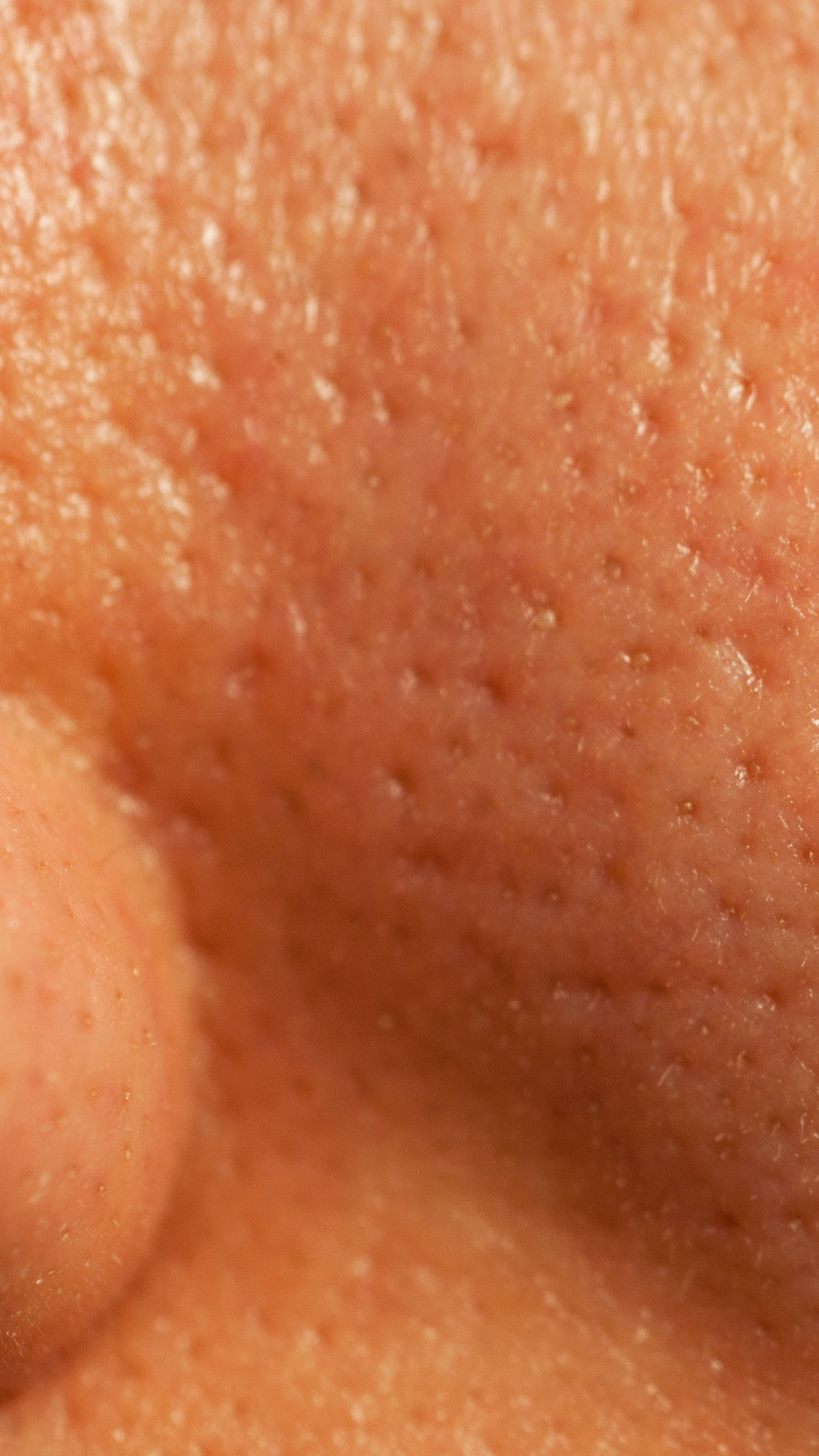Large Pores Treatment in London & Kingston, Surrey – It's Me & You