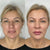 Non-Surgical Liquid Facelift – It's Me & You