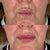 Dermal filler injections for smokers lines at It’s Me and You Clinic in Kingston upon Thames, Surrey and London – enhancing lip contour and smoothing perioral wrinkles.