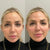 Cheek filler at It’s Me and You Clinic in London, Kingston upon Thames and Surrey – dermal fillers to enhance cheek volume, lift sagging skin and define facial contours.