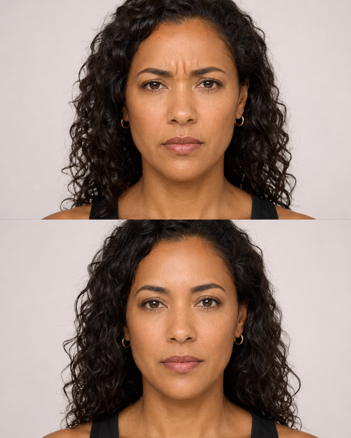 Alluzience before and after portrait showing softened frown lines and a smoother natural looking expression after anti wrinkle treatment in Kingston upon Thames, Surrey and London