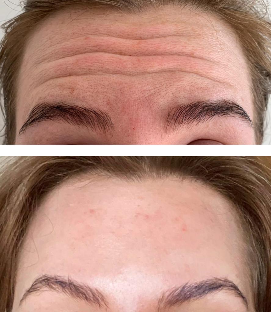 Brow Lift in Surbiton - Consultation