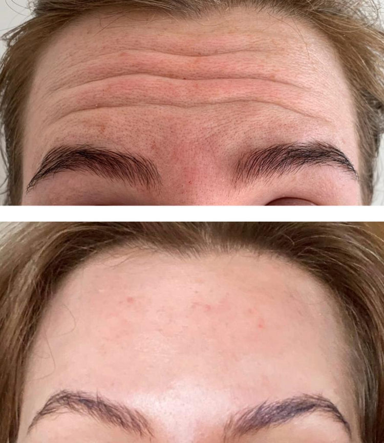 Botox Nasal Flare Treatment in Notting Hill, London