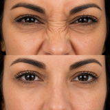 Before and after bunny lines treatment showing visibly softened nose wrinkles in a different female client.