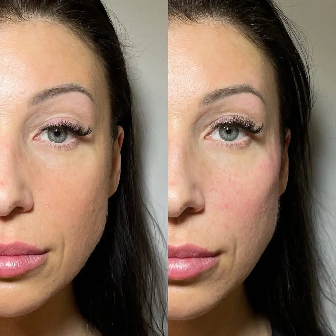 Cheek Filler Before And After