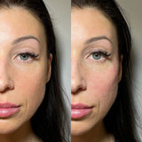 It’s Me and You Clinic cheek filler results – before and after in London, Surrey and Kingston upon Thames