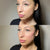Cheek filler before and after at It’s Me and You Clinic in Kingston upon Thames, Surrey and London