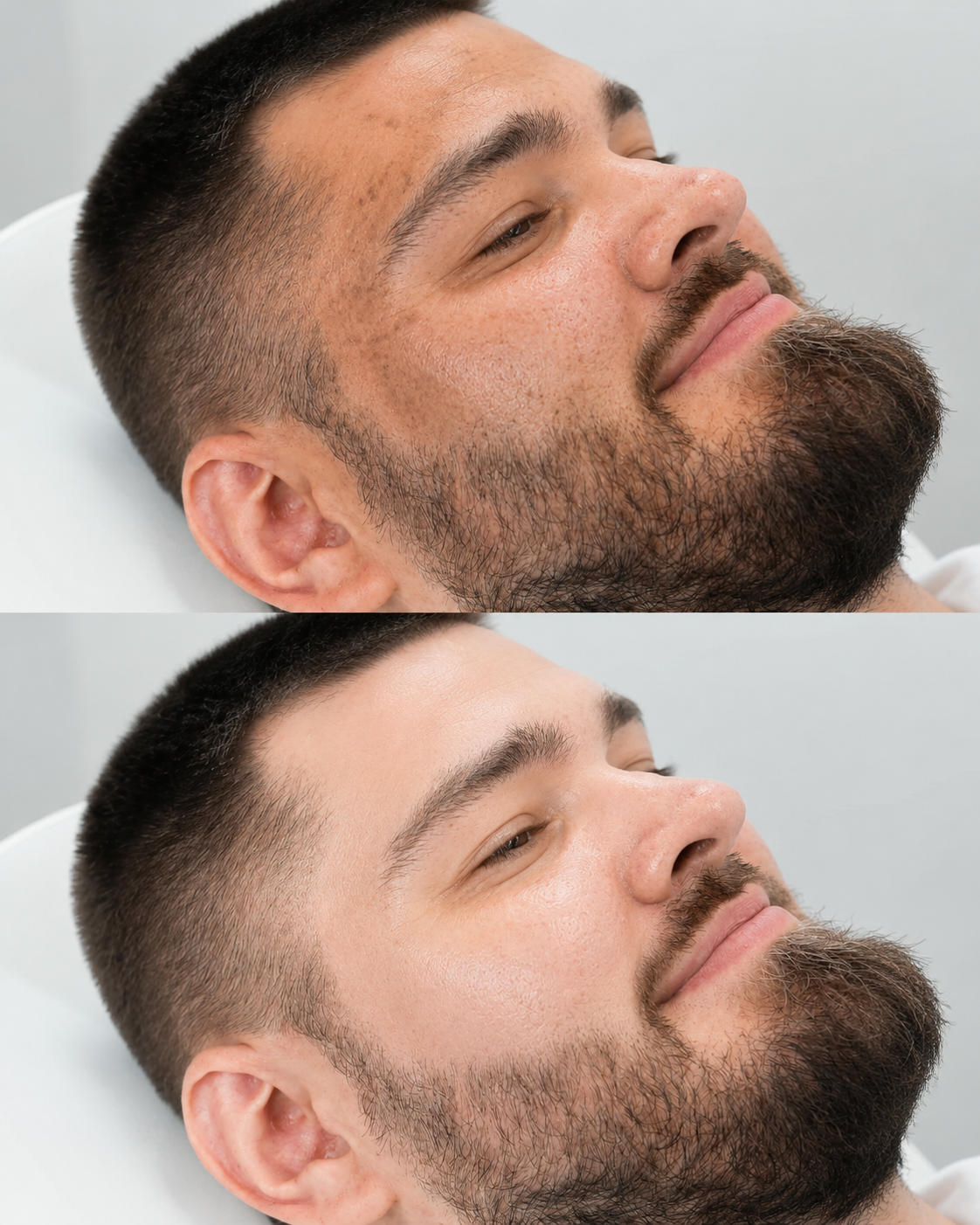 Cosmelan depigmentation peel before and after style image showing visibly clearer looking skin and reduced pigmentation at It’s Me & You Skin Clinic in Kingston upon Thames, Surrey.