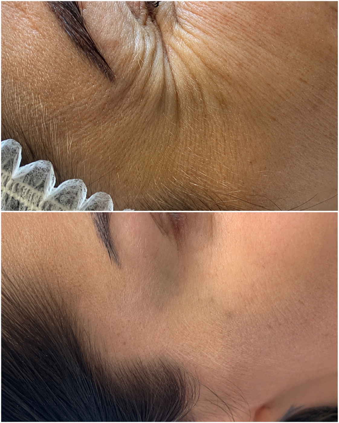 Close up before and after image of the eye area following crow’s feet Botox treatment at It’s Me & You Skin Clinic in Kingston upon Thames, Surrey and London.