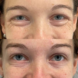 Anti-wrinkle treatment for crow’s feet at It’s Me and You Clinic in London, Kingston upon Thames and Surrey – effective injectable therapies to reduce eye wrinkles.