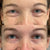 Anti-wrinkle treatment for crow’s feet at It’s Me and You Clinic in London, Kingston upon Thames and Surrey – effective injectable therapies to reduce eye wrinkles.