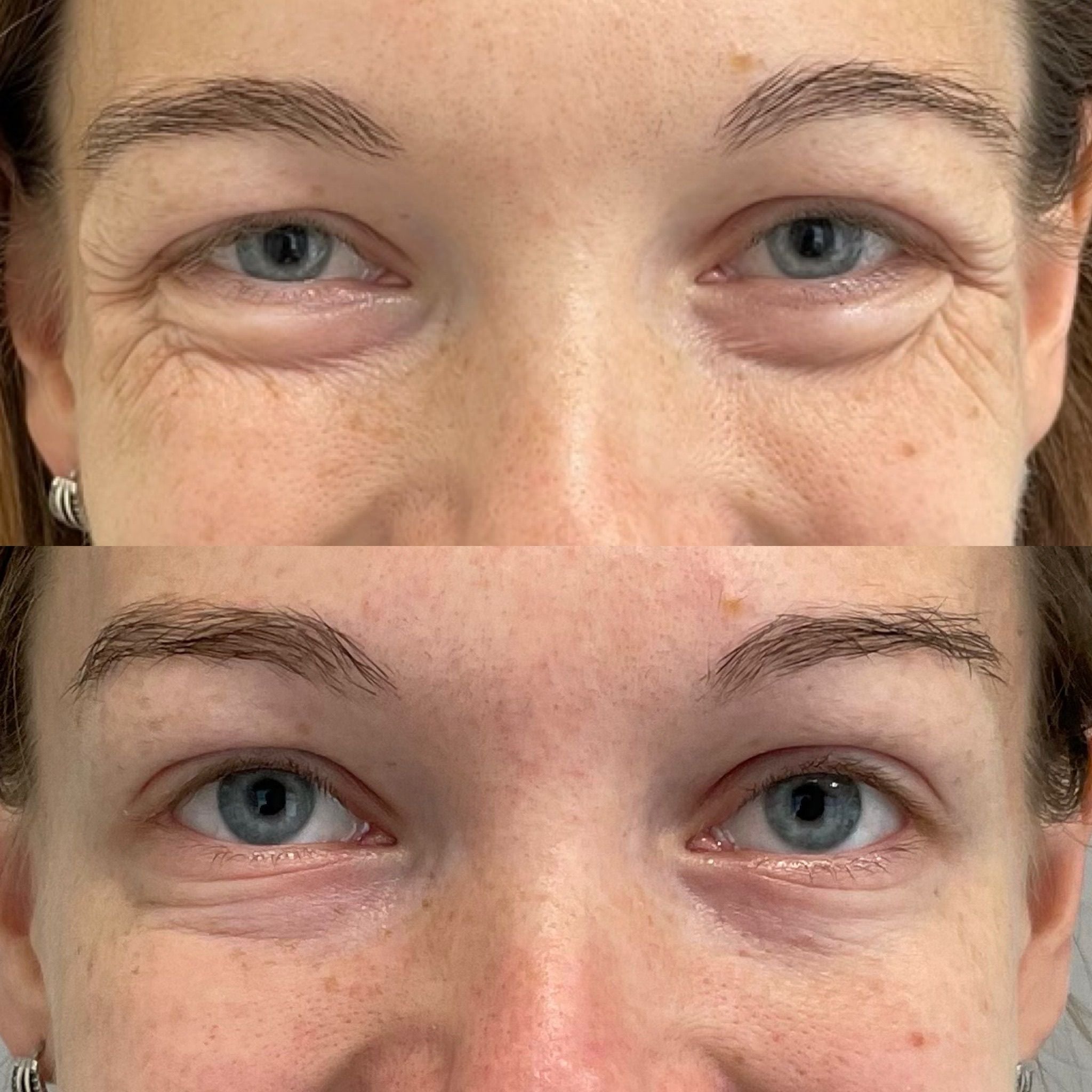 Botox Jaw Slimming (Masseter Reduction) in Primrose Hill, London