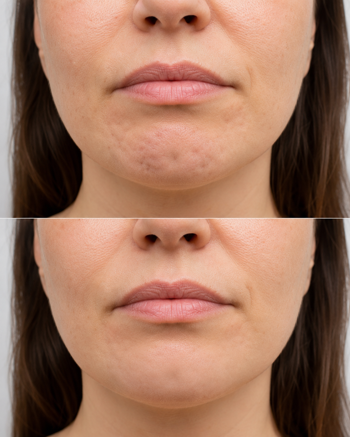 Before and after image showing dimpled chin treatment for chin dimpling and smoother lower face contour at It’s Me & You Skin Clinic in Kingston upon Thames, serving Surrey and London.