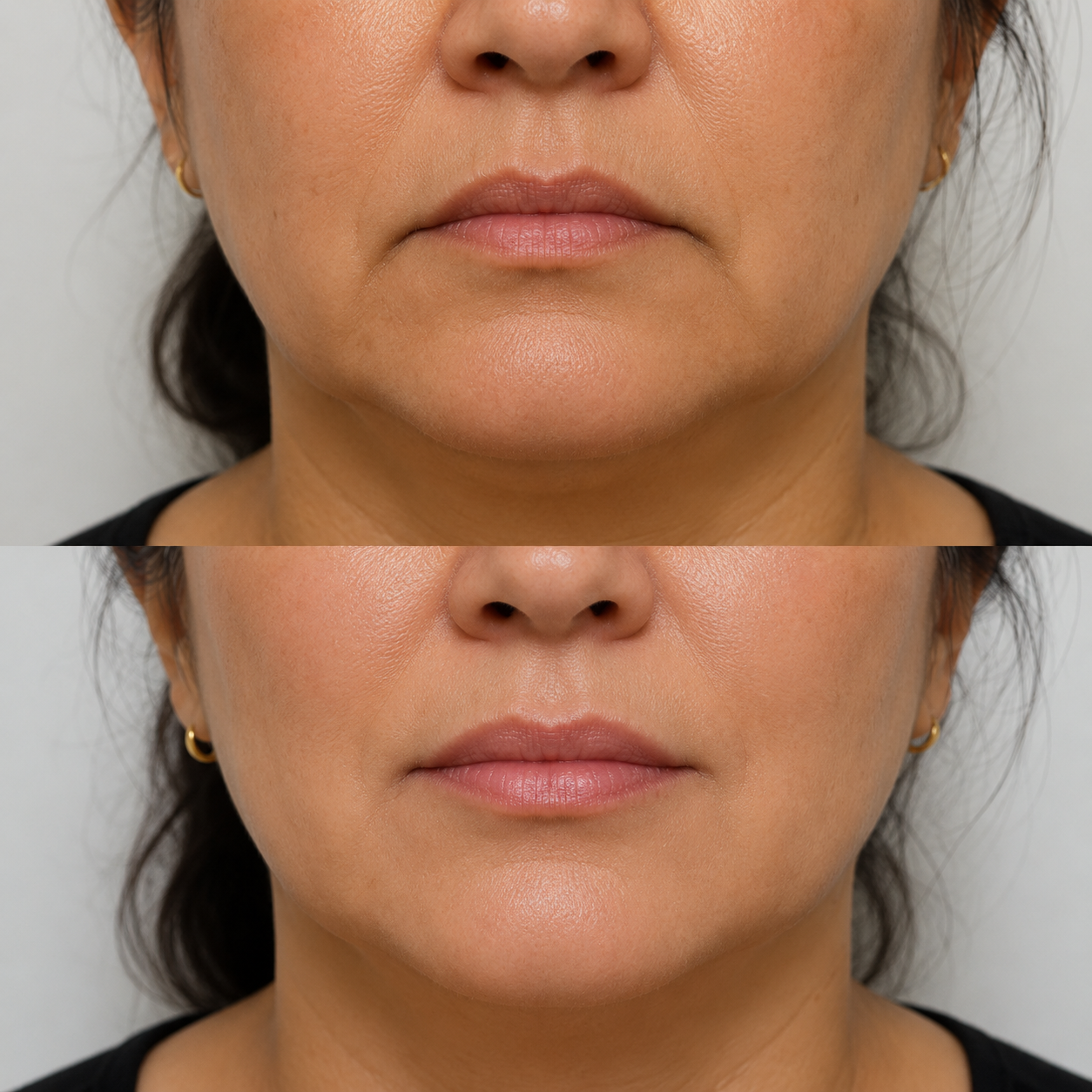 Before and after image of a downturned mouth corner treatment on a different client, showing softened downward pull and a more neutral resting mouth position.