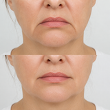 Before and after image of a downturned mouth corner treatment on a different client, showing reduced downward pull at the mouth corners and a softer, more neutral resting expression.