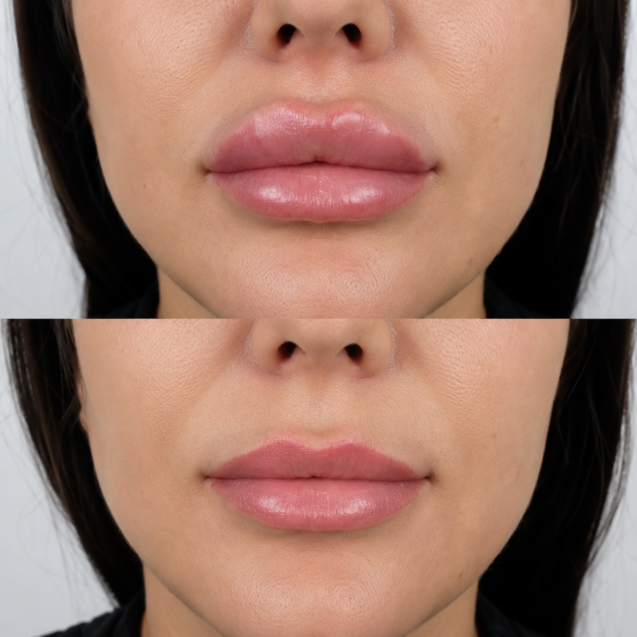 Before and after lip filler dissolving showing reduced excess volume, improved lip shape and a more natural-looking contour.