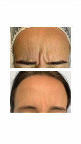 Forehead Frown Lines Treatment – It's Me & You