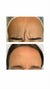 Forehead Frown Lines Treatment – It's Me & You