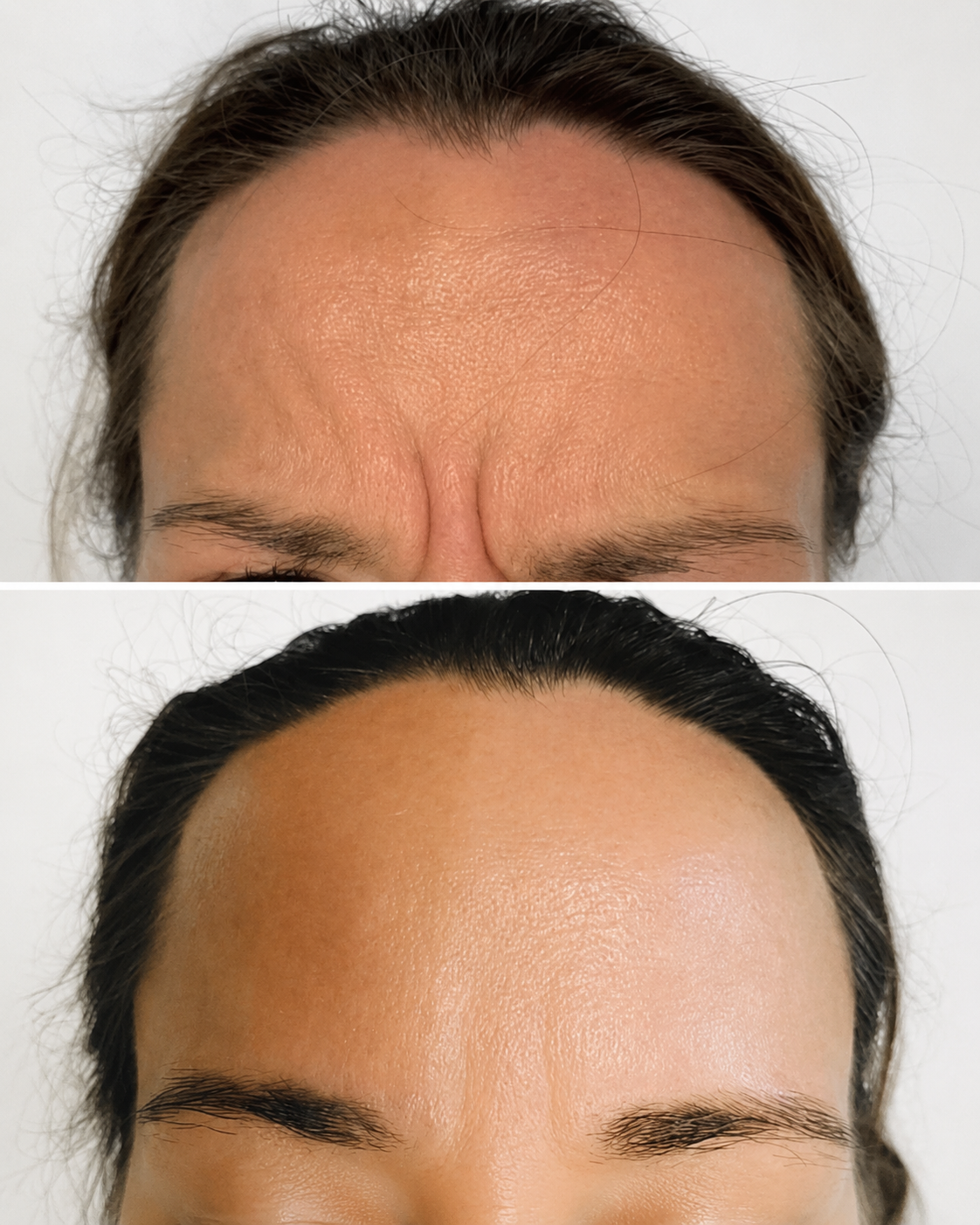 Before and after forehead and frown line treatment image showing a smoother upper face appearance at It’s Me & You Skin Clinic in Kingston upon Thames, Surrey.