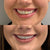 Natural smile enhancement – gummy smile treatment results from It’s Me & You Clinic London, Surrey, Kingston