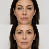 Before and after HArmonyCa treatment showing improved facial support, softer contours and a more refreshed appearance.