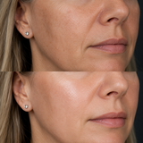 Illustrative Jalupro Super Hydro before and after close-up showing smoother texture, improved hydration and brighter-looking skin across the cheek and lower face.