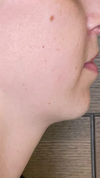 Non-surgical jowl treatment at It’s Me and You Clinic in London, Kingston upon Thames and Surrey – jawline fillers, skin tightening and lifting treatments to reduce sagging jowls.