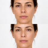 Illustrative Juvéderm Volite before and after comparison showing improved facial skin hydration, smoothness and radiance.