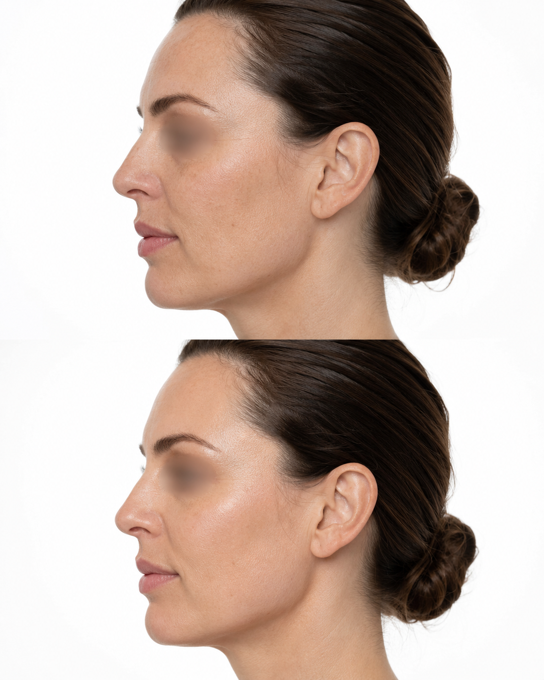 Juvéderm Volite skin booster before and after side profile image showing smoother, more hydrated looking skin after treatment at It’s Me & You Skin Clinic in Kingston upon Thames, Surrey