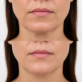 Before and after labiomental crease filler showing reduced horizontal chin indentation and a more even chin profile.