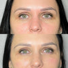 Light Eyes Ultra dark circles treatment at It’s Me and You Clinic in Kingston upon Thames, Surrey and London – brightening eye mesotherapy for dark circles, under-eye bags and puffiness.