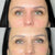 Light Eyes Ultra dark circles treatment at It’s Me and You Clinic in Kingston upon Thames, Surrey and London – brightening eye mesotherapy for dark circles, under-eye bags and puffiness.