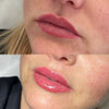 Lip flip at It’s Me and You Clinic in London, Kingston upon Thames and Surrey – non-surgical lip enhancement using Botox for subtle volume and improved lip definition.