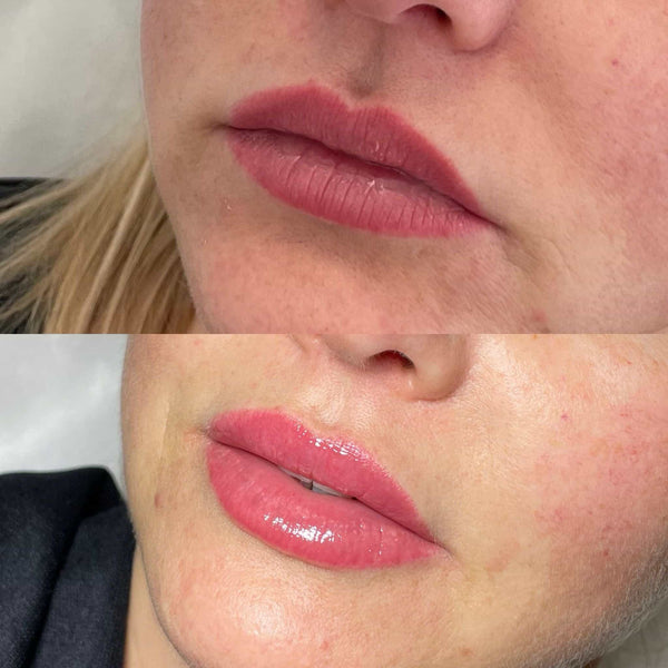 Lip flip at It’s Me and You Clinic in London, Kingston upon Thames and Surrey – non-surgical lip enhancement using Botox for subtle volume and improved lip definition.