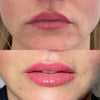 Lip filler before and after gallery at It’s Me and You Clinic in London, Kingston upon Thames and Surrey – expert lip injections with visible transformation and enhanced lip shape.