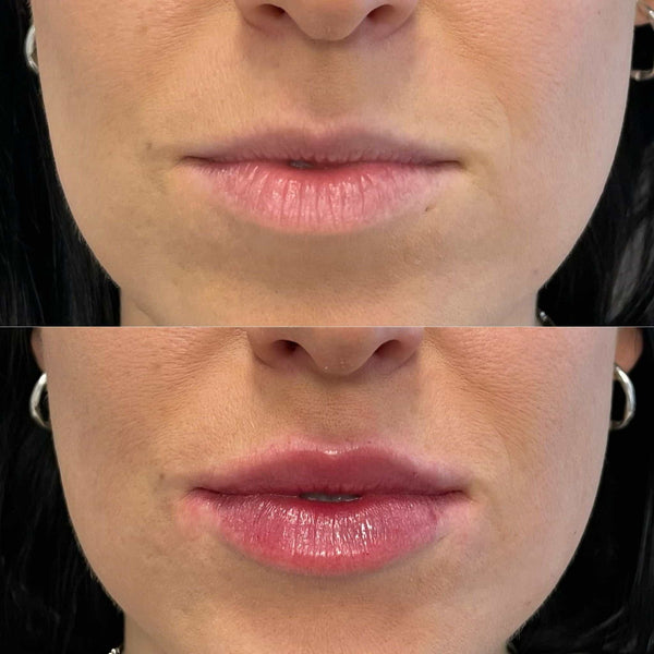 Lip flip treatment at It’s Me and You Clinic in London, Kingston upon Thames and Surrey – gentle Botox injections to lift the upper lip and reduce smoker’s lines for a youthful appearance.