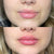 Dissolving lip fillers at It’s Me and You Clinic in Kingston upon Thames, Surrey and London – safe hyaluronidase injections to reverse unwanted dermal fillers.