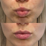 Dissolve unwanted lip fillers at It’s Me and You Clinic in Kingston upon Thames, Surrey and London – hyaluronidase treatment for safe and effective filler removal.