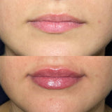 Before and after lip filler images from It’s Me and You Clinic in London, Kingston upon Thames and Surrey – showcasing smooth and fuller lips.