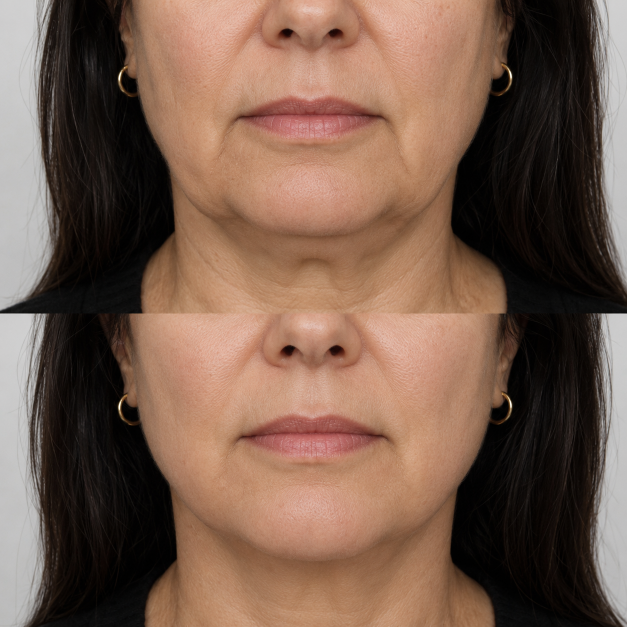 Before and after jowl treatment showing reduced lower face heaviness and a smoother, more defined jawline contour.