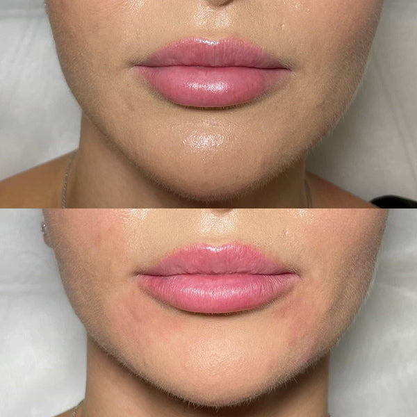 Before and after lip filler and marionette line treatment at It’s Me and You Clinic in London, Kingston upon Thames and Surrey – correcting sad smile and downturned mouth corners.