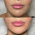 Before and after lip filler and marionette line treatment at It’s Me and You Clinic in London, Kingston upon Thames and Surrey – correcting sad smile and downturned mouth corners.