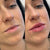 Nasal Flare Treatment in Kingston upon Thames, Surrey – Natural Nose Reshaping with Botox – It's Me & You