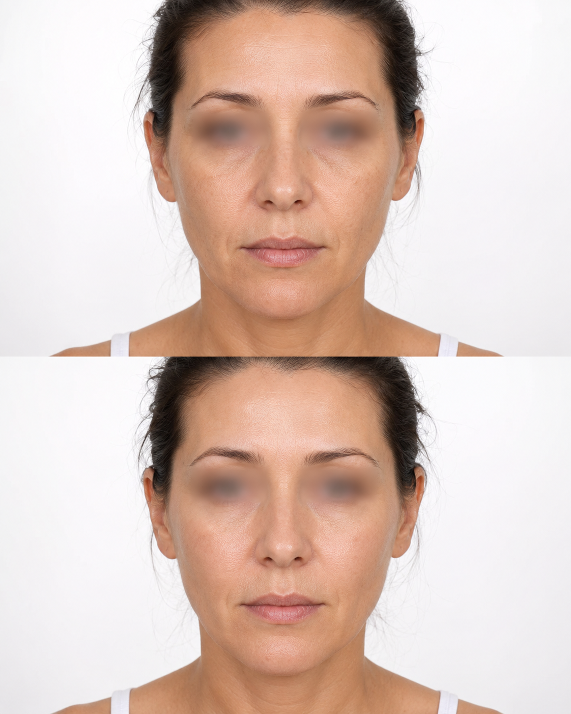 Before and after Neauvia Hydro Deluxe skin booster treatment showing a front facing female patient with blurred eyes against a white background.
