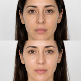 Illustrative Neauvia Hydro Deluxe before and after image showing improved facial hydration, smoother texture and a brighter-looking complexion.