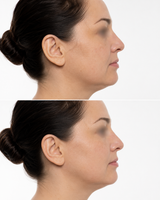 Side profile before and after image of Neauvia Hydro Deluxe skin booster treatment showing improved skin hydration and texture with blurred eye area on a white background