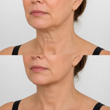Before and after image of a non-surgical Nefertiti neck lift treatment showing the lower face and neck, with the before image on top and the after image below, highlighting a smoother neck and more defined jawline.