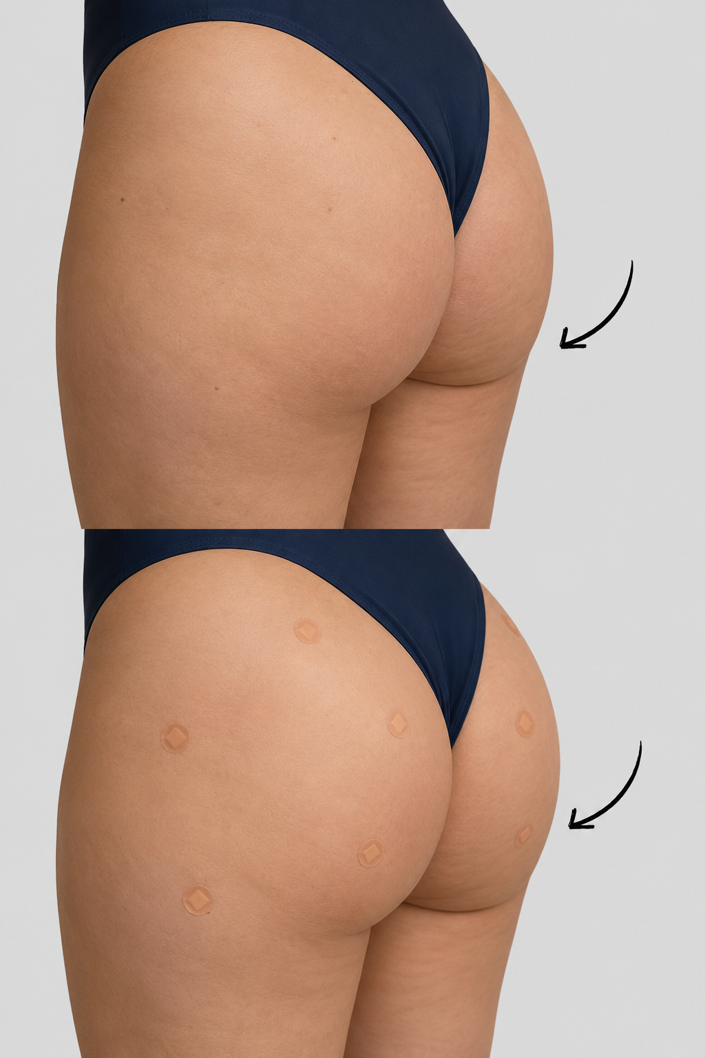 Before and after style image showing a Non Surgical Bum Lift BBL with PLLA result for body contouring at It’s Me & You Skin Clinic in Kingston upon Thames, Surrey and London