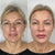Radiesse dermal fillers at It’s Me and You Clinic in Kingston upon Thames, Surrey and London – liquid facelift procedure to smooth wrinkles and enhance facial contours.
